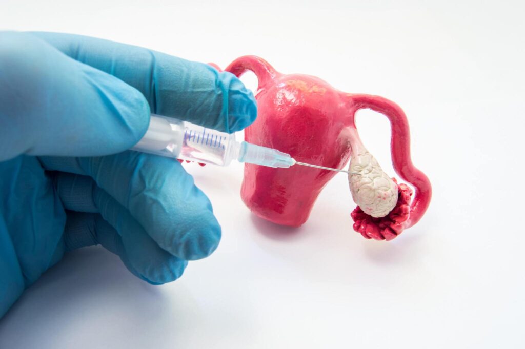 Ovarian Induction in Delhi