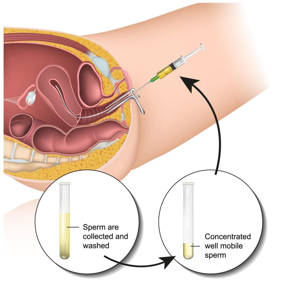 Intrauterine Insemination (IUI Treatment in dwarka, Delhi)