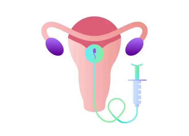 Intrauterine Insemination (IUI) in Dwarka, Delhi