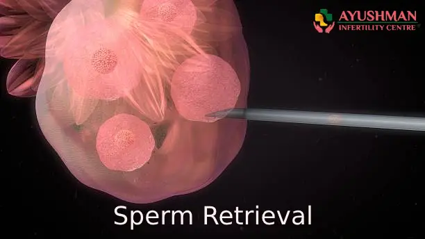 Why and When is Sperm Retrieval Done?