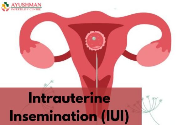 Things You Must Know About Intrauterine Insemination (IUI)