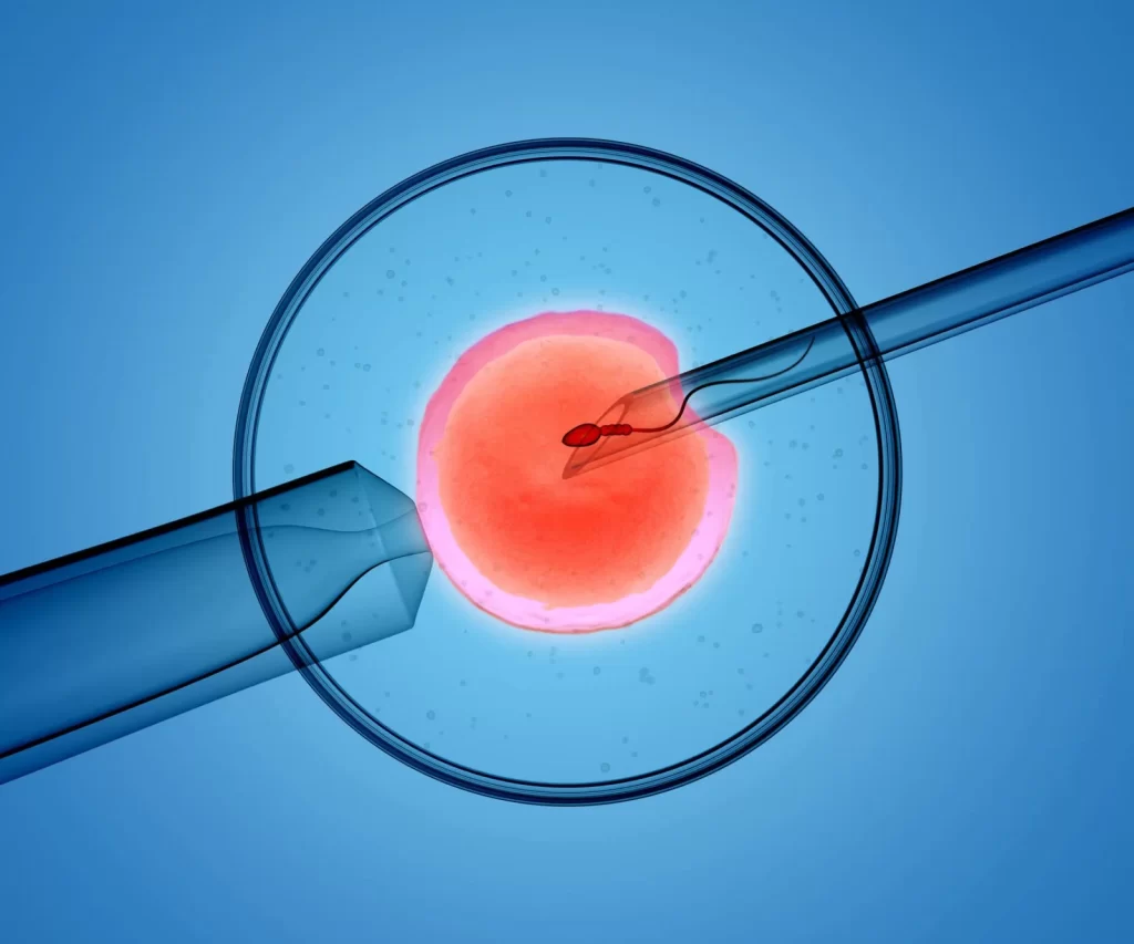 Intracytoplasmic sperm injection - ICSI treatment Intracytoplasmic sperm injection - ICSI treatment