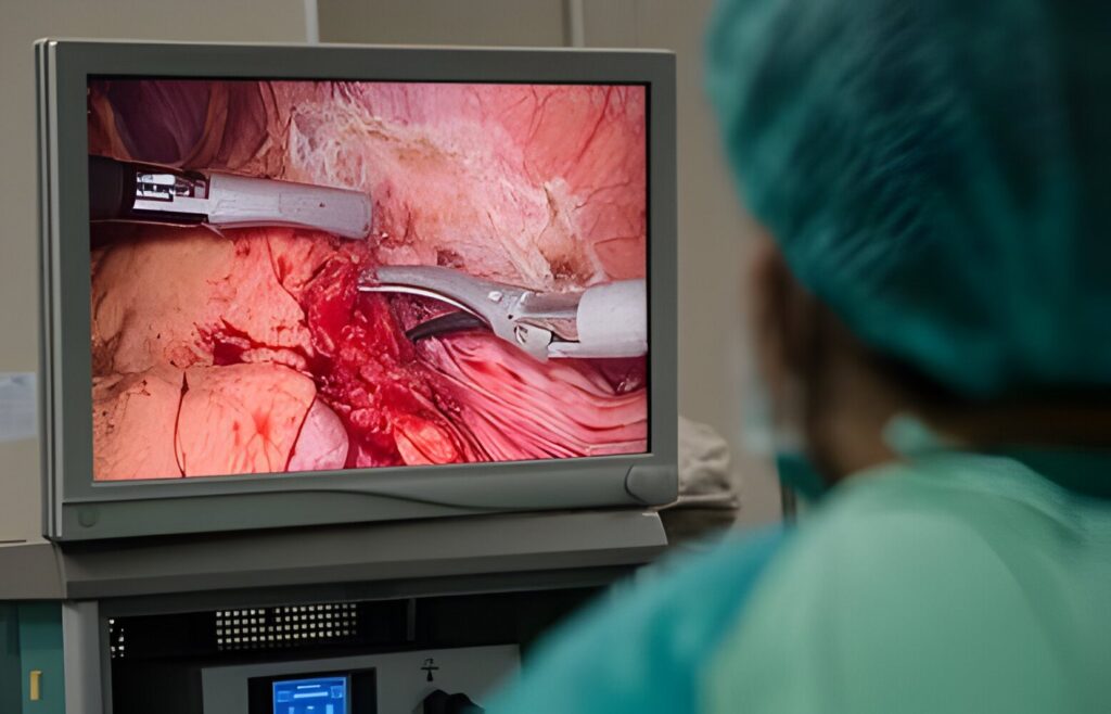 Types of Laparoscopy